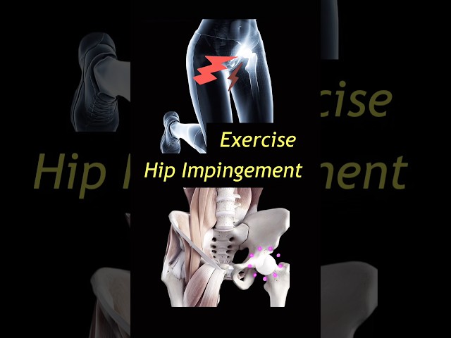 Hip Impingement. Groin Pain or Rubbing. Hip Stiffness. FAI femoroacetabular