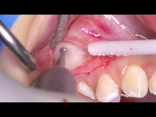 Dental Surgery: Small Cyst Removal by Oral Surgeon Dr Juraj Brozović Using Resorba Gentacoll Cones