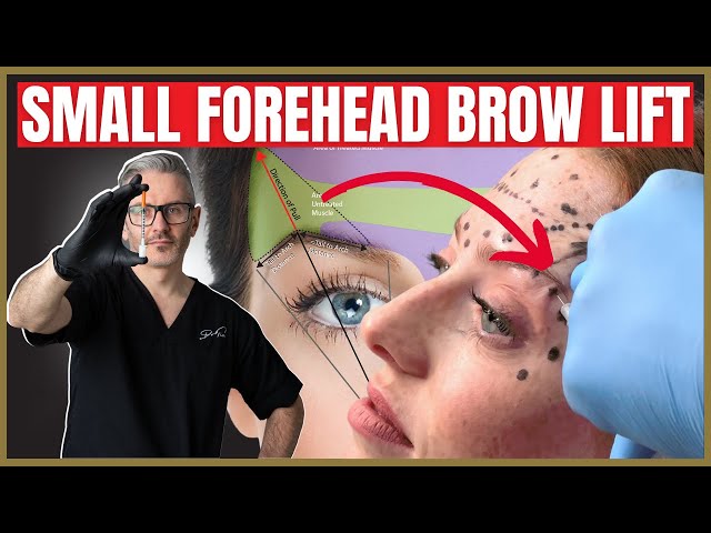 How To Perform a Botox Brow lift on a small forehead.