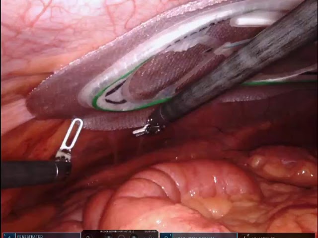 Robotic ventral hernia repair with mesh by Dr. Iraniha