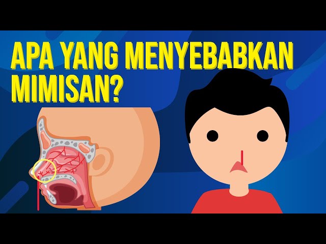 Apa yang Menyebabkan Mimisan?