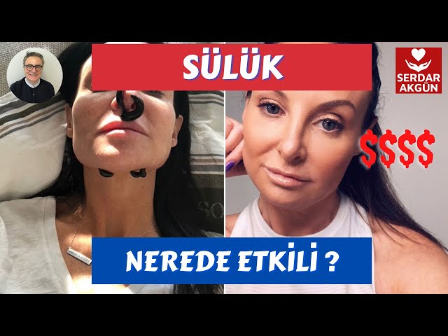 Sülük, Tedavisi Nerede etkili?, Prof.Dr.Serdar Akgün, Sağlık Videoları, Sağlık Haberleri