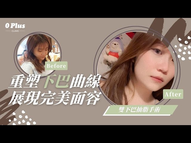 小臉美顏術💫 雙下巴抽脂Q&A｜0Plus Clinic