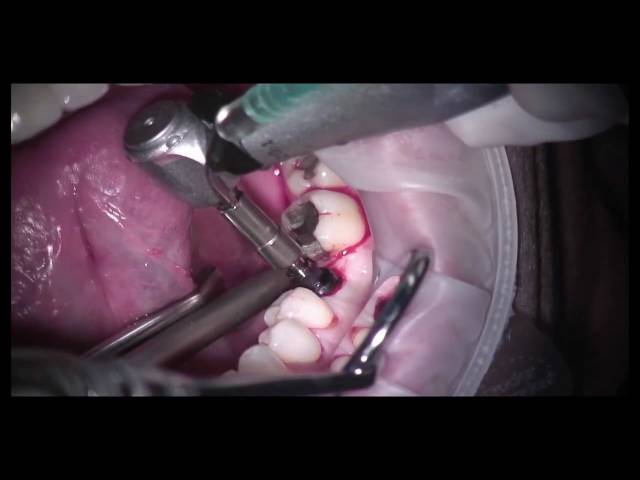 Guided Dental Implant Surgery: Part 2