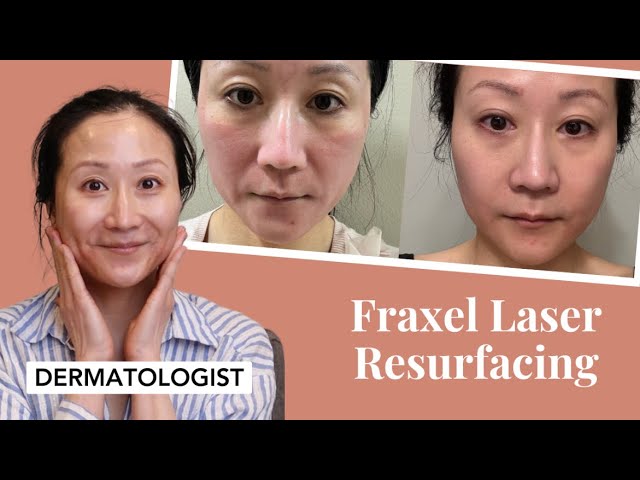 Dermatologist's experience with Dual Faxel Laser | Dr. Jenny Liu