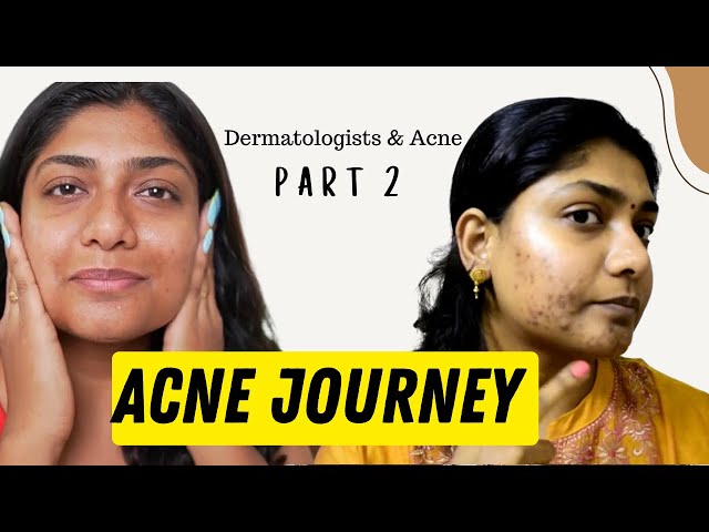 Acne & Dermatologists | I wish my dermats told me these before !! Part 2 Acne Journey 10/22