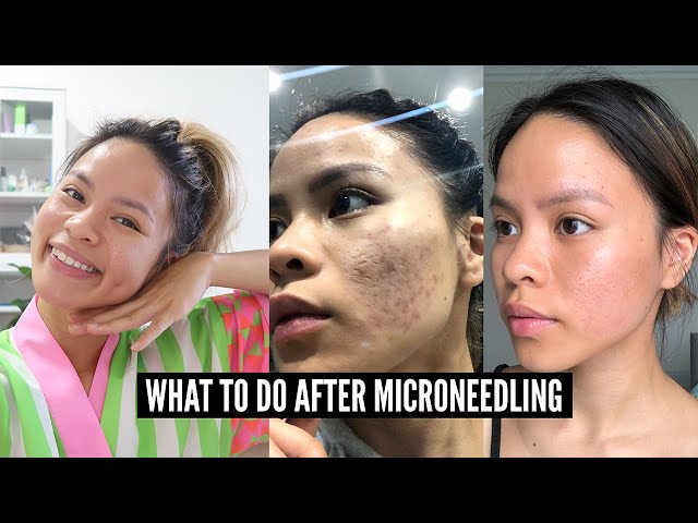 12 Important Microneedling Aftercare Tips