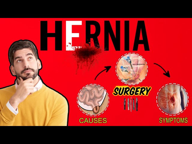 ✅ Hernia Basics , Defination , Causes , Surgery , Symptoms #mbbs #doctor #surgeon #surgeryday