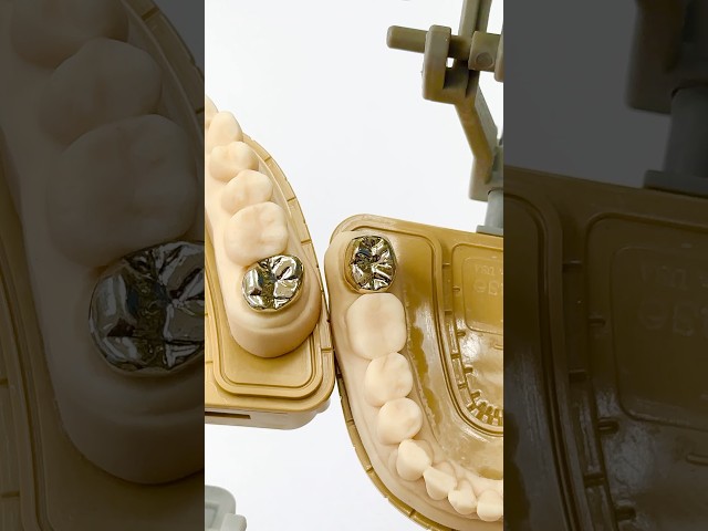 Double Gold Molars #lsk121shorts #dental #teeth