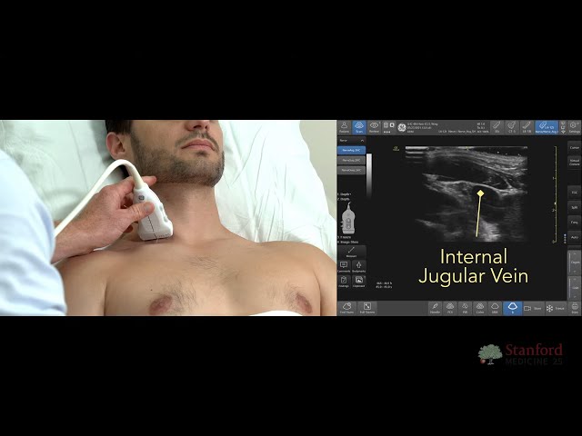 Using Ultrasound to Examine Neck Veins (POCUS)