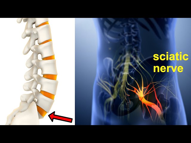 Sciatica Pain Treatment At Home | how to get rid of sciatica pain in leg