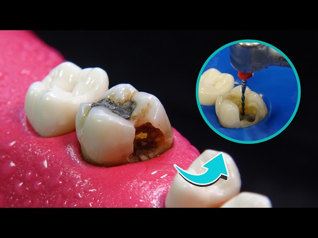 Tooth restoration: Root Canal Treatment and INLAY