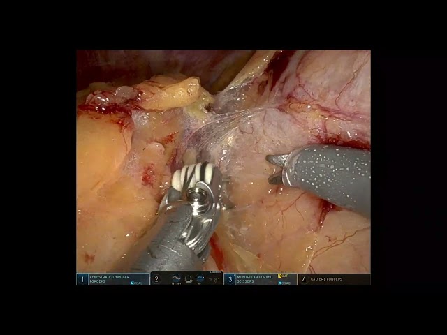 Left robotic radical nephrectomy upper pole T3 tumour morbidly obese