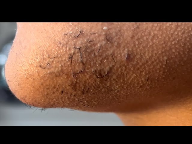 INGROWN HAIR REMOVAL #104 - Plucking the hairs on my chinny chin chin