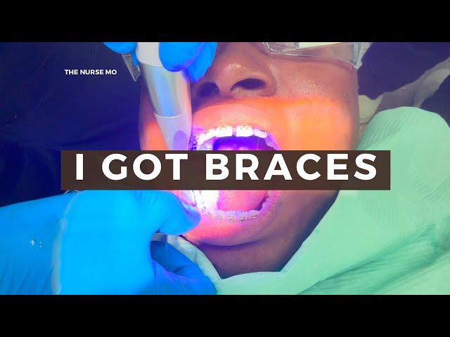 Life Lately | My Braces Journey.