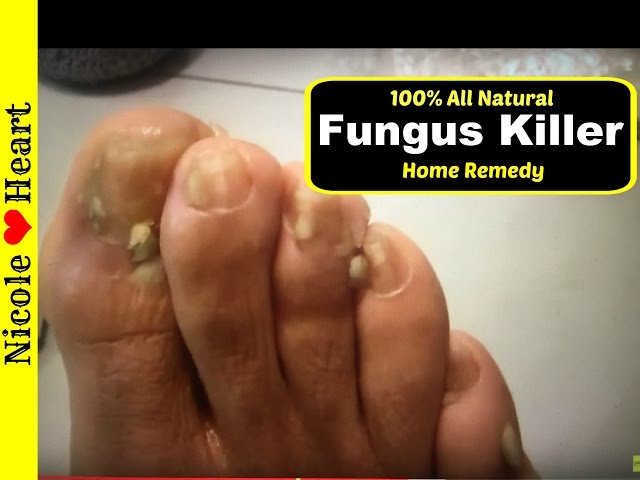 Home Remedy for Toenail Fungus & Athlete's Foot | Natural Fungus Killer by Nicoles Heart