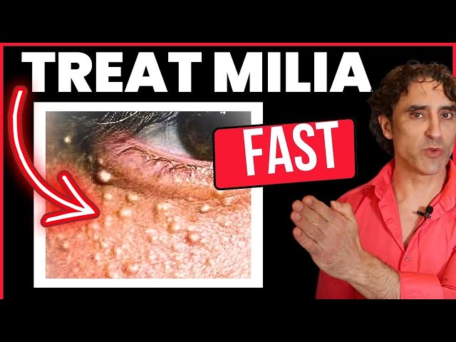 MILIA // How To Treat and Prevent Them