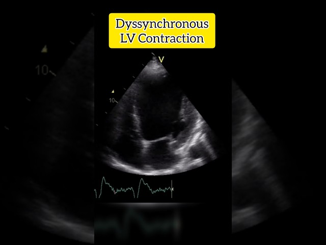 Dyssynchronous and Dilated Left Ventricle #anatomy #heart #cardiology #echocardiography