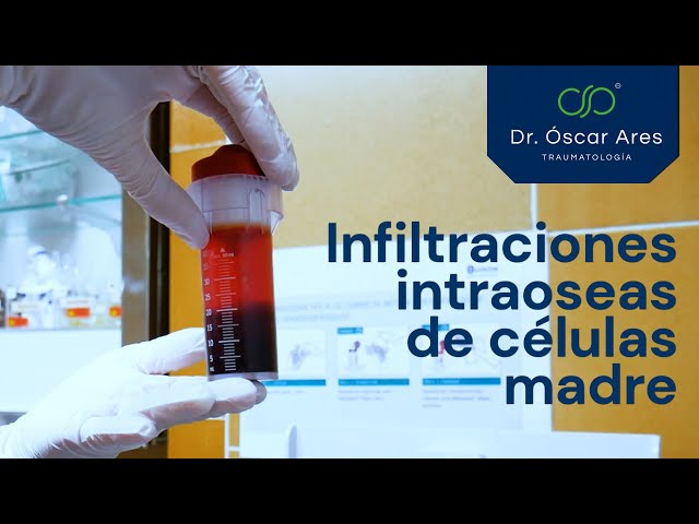 Infiltraciones intraoseas de células madre - Dr. Oscar Ares