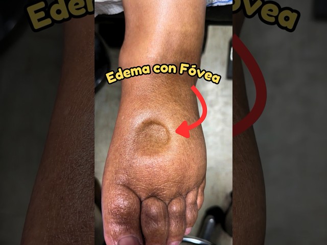 #edema  con fóvea, un posible signo de otras #condiciones! - Doctores Especialistas