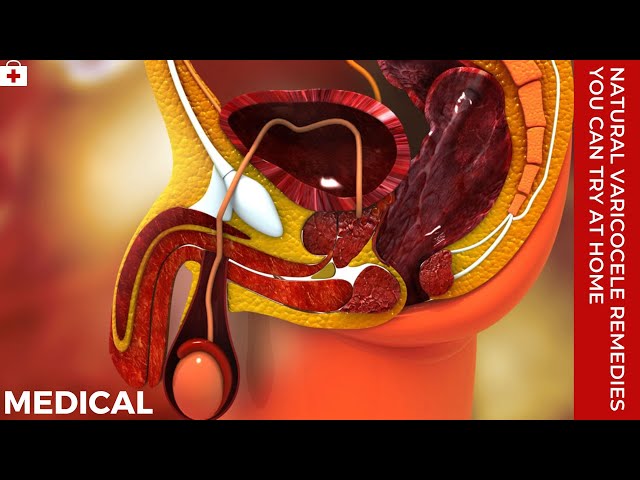 Natural Varicocele Remedies You Can Try At HOME