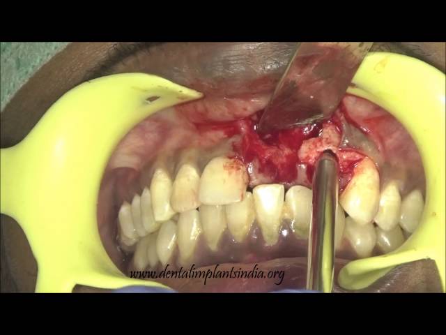 Huge dental cyst/abcess in maxilla removal and immediate basal implants placement-video