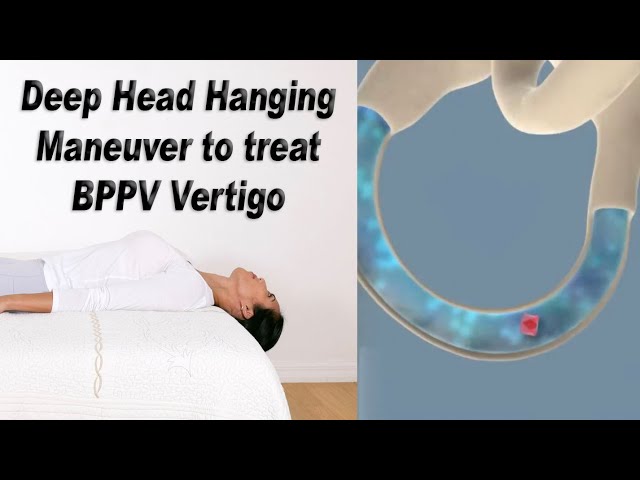 Deep Head Hanging Maneuver to Treat BPPV Vertigo