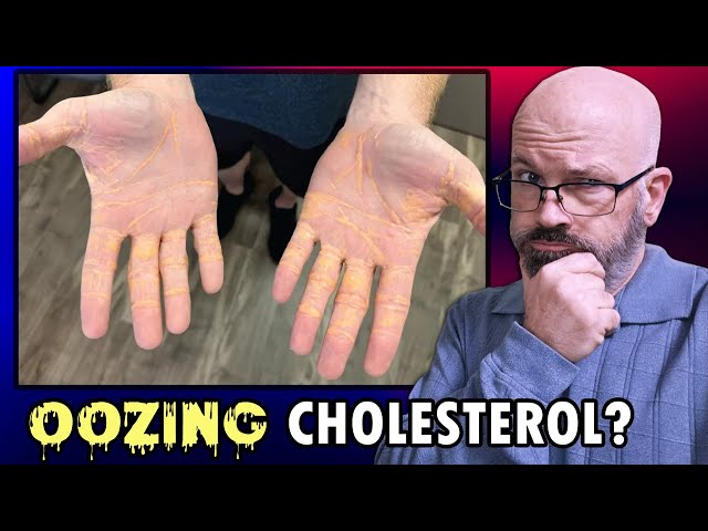 Xanthelasma and the Carnivore Diet - Oozing Cholesterol?