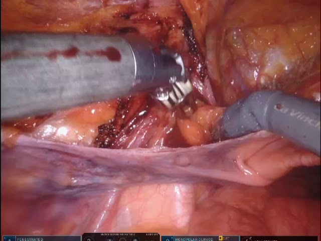 Robotic bilateral inguinal hernia repair with mesh by Dr. Iraniha