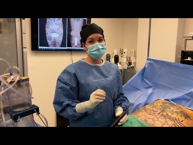 BBL with liposuction 360 and VASER for more defined curves