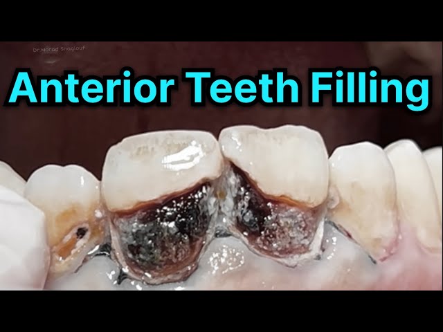 Anterior Teeth Composite Restoration With Fiber Post