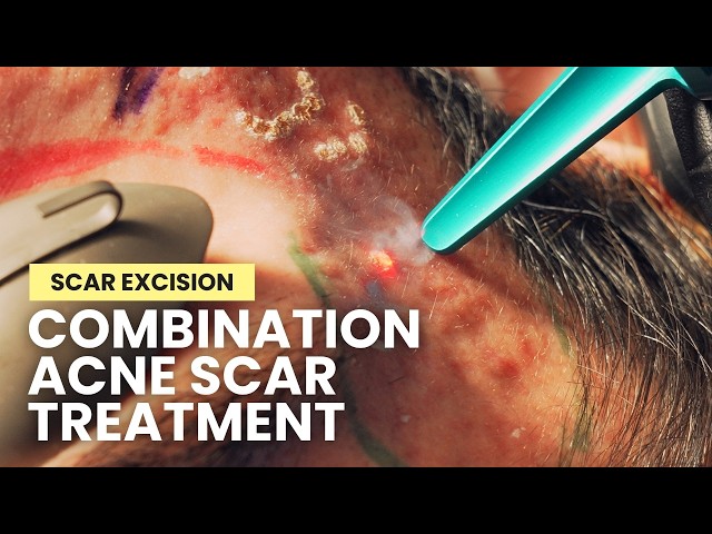 Excising Acne Scars: TCA Cross, Subcision, Punch Excision, Elliptical Excision, Bellafill