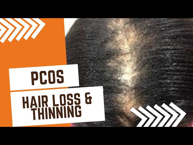 Hair loss from PCOS| PCOS hair thinning | how to care for hair PCOS | polycystic ovary syndrome￼