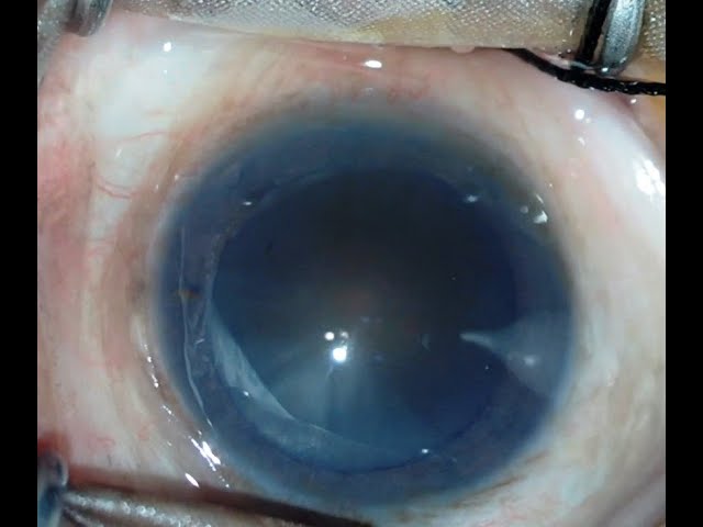 Management of Cataract Nigra HD