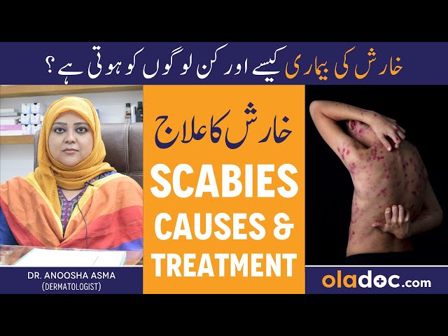 KHARISH KA ILAJ - Scabies Treatment In Urdu - Kharish Ki Bimari Kyun Hoti Hai - Itching Solution