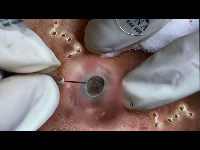 Big Cystic Acne Blackheads Extraction Blackheads & Milia, Whiteheads Removal Pimple Popping #094