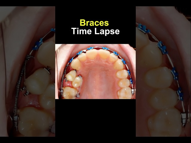 Braces time lapse. Before and after transform #braces #orthodontist #bracesoff #dentist