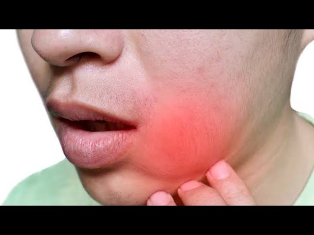 How to treat dental abscess and swelling very fast