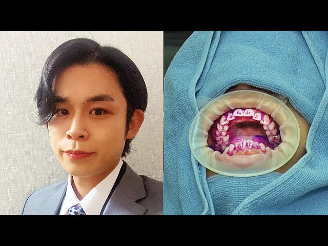 Realtor Aoki’s Teeth Stain Removal Challenge!