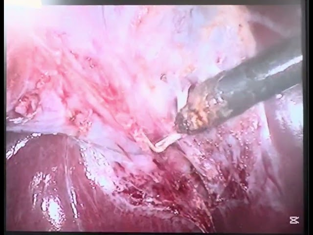 Laparoscopic cholecystectomy unedited 2x speed