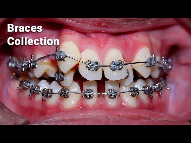 braces process collection