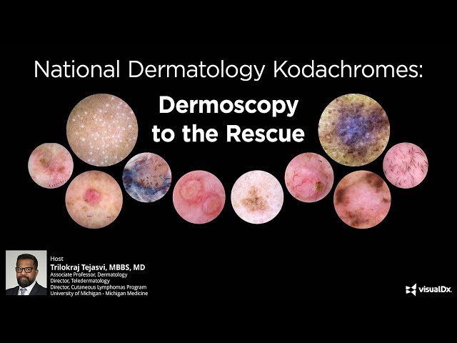 National Dermatology Kodachromes: Dermoscopy to the Rescue