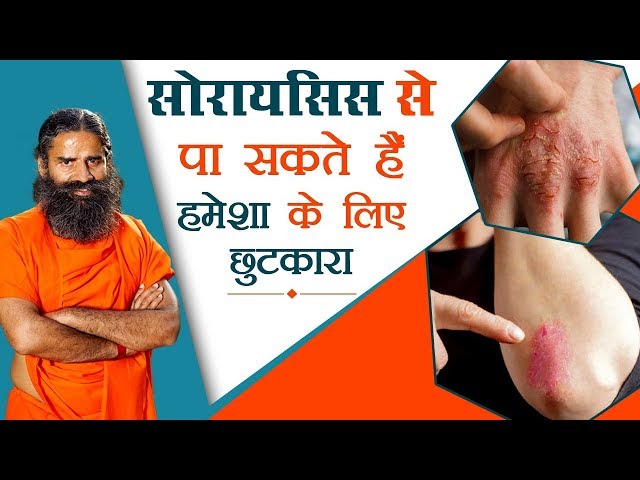 सोरायसिस (Psoriasis) से पा सकते हैं हमेशा के लिए छुटकारा | Swami Ramdev