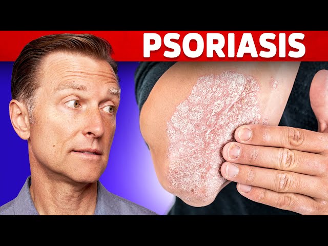 Psoriasis Treatment – The Best 3 Remedies for Psoriasis – Dr.Berg