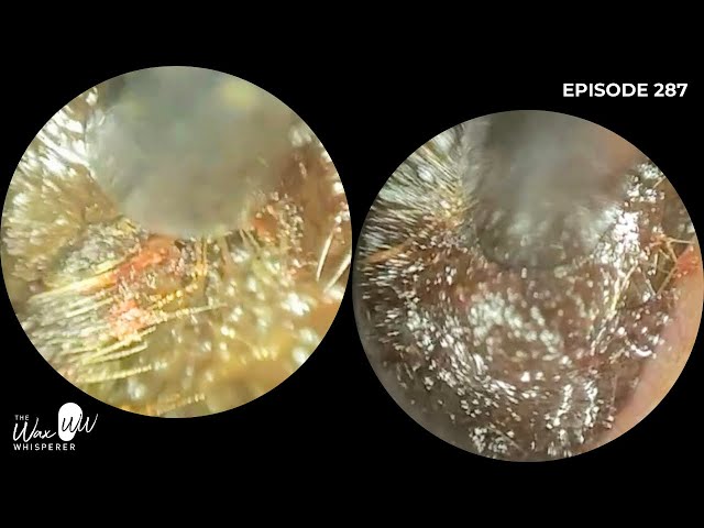 287 - Severe Ear Wax Blockage Removed using the WAXscope®️