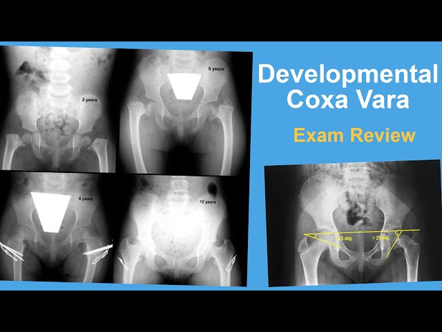 Developmental Coxa Vara Exam Review - Ernie Sink, MD