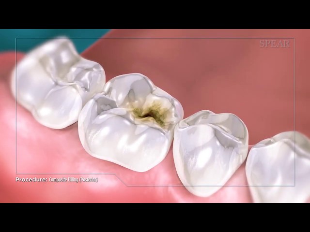 Composite Fillings