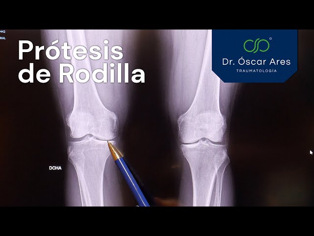 Prótesis de Rodilla - Dr. Oscar Ares