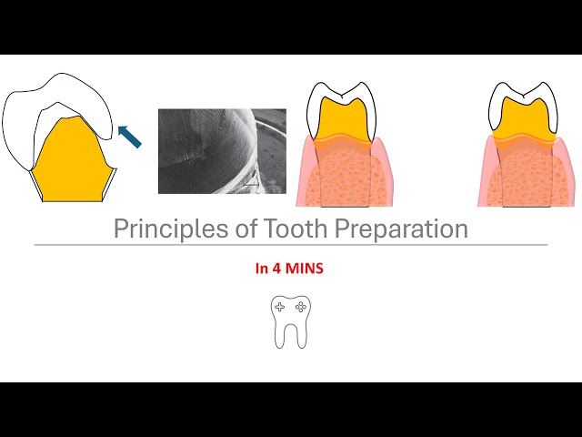 Principles of crown preparation