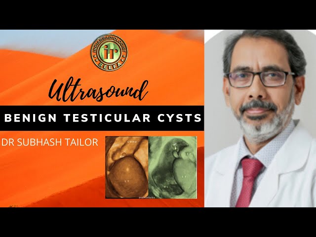 BENIGN TESTICULAR CYSTS | DR SUBHASH TAILOR | SCROTAL ULTRASOUND | TESTES DOPPLER | TUBULAR ECTASIA